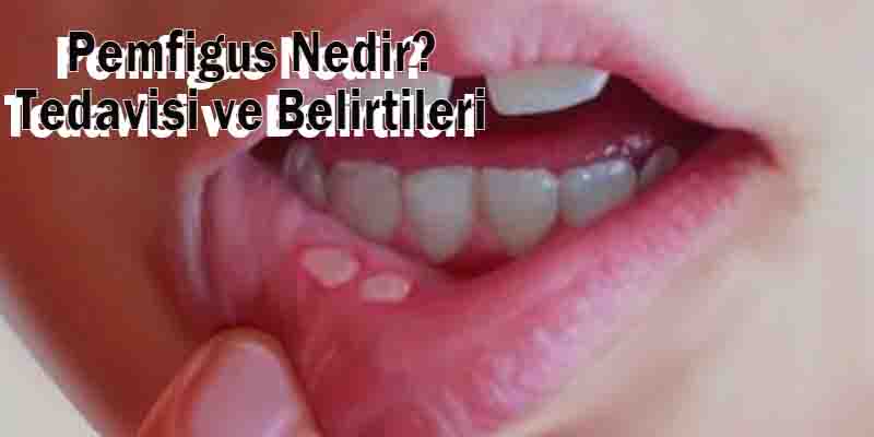 Pemfigus Nedir? Tedavisi ve Belirtileri