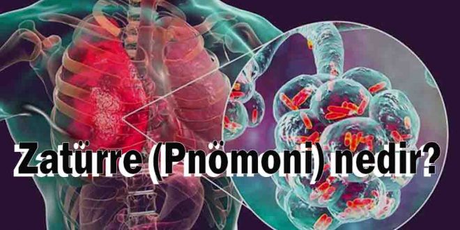 Zatürre (Pnömoni) nedir?