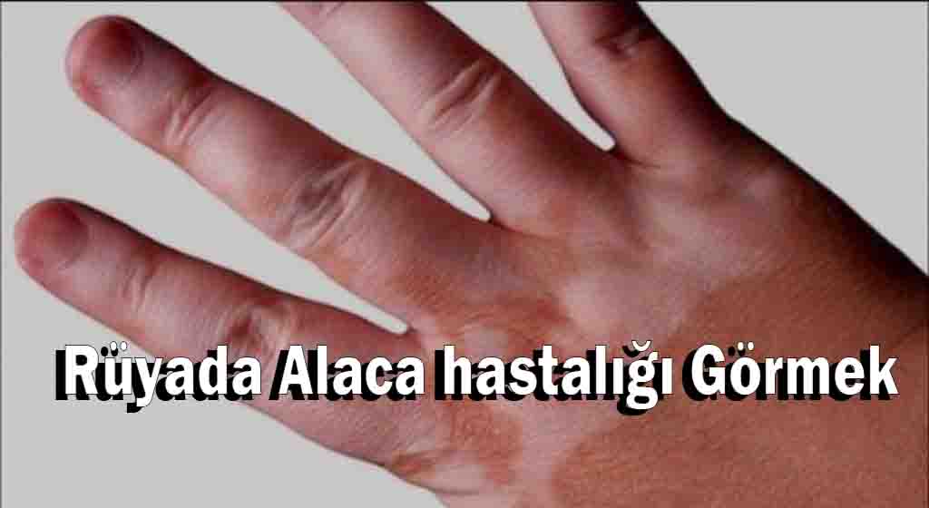 Rüyada Alaca hastalığı Görmek